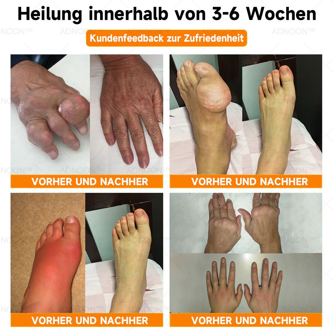 🎁Blitzangebot - ODALIT™ Botulinumtoxin & Bienengift Schmerzlindernde Knochenheilcreme🐝💎